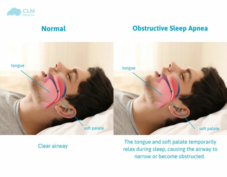 Obstructive Sleep Apnea (OSA) is a common but serious sleep disorder. It