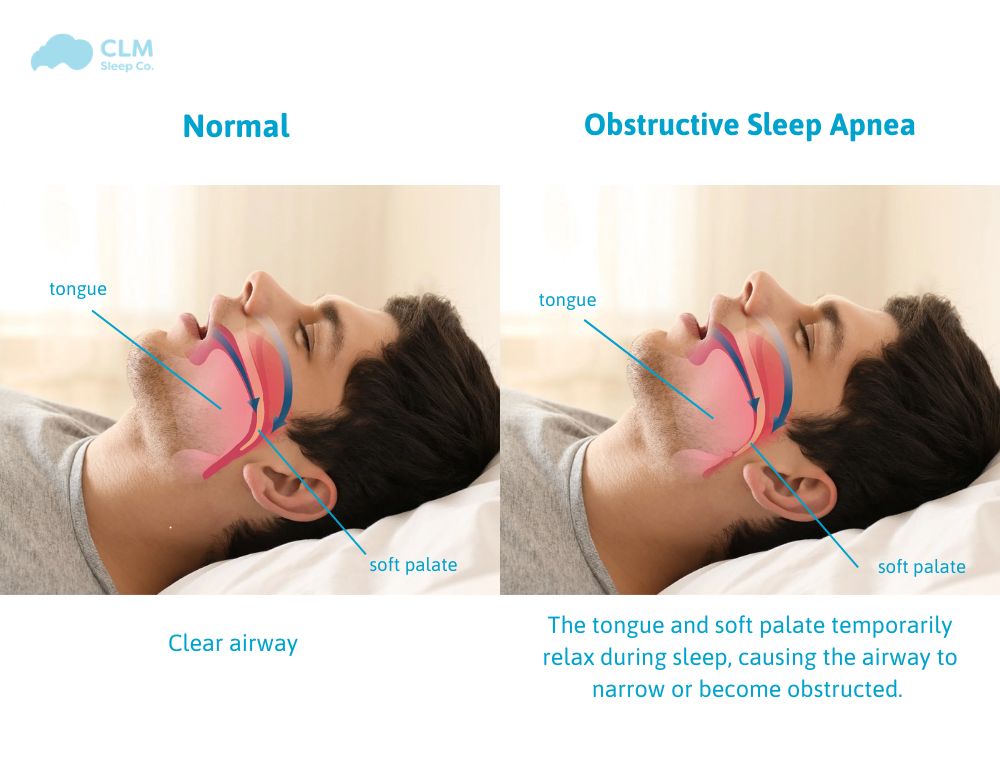 Obstructive Sleep Apnea (OSA) is a common but serious sleep disorder. It