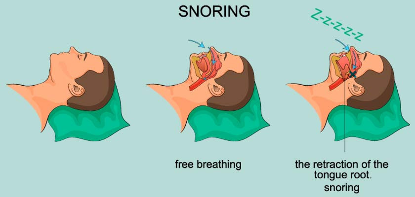 Loud Snoring – A Key Symptom of Obstructive Sleep Apnea