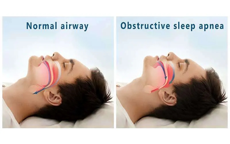 A common symptom of obstructive sleep apnea is gasping or choking during sleep