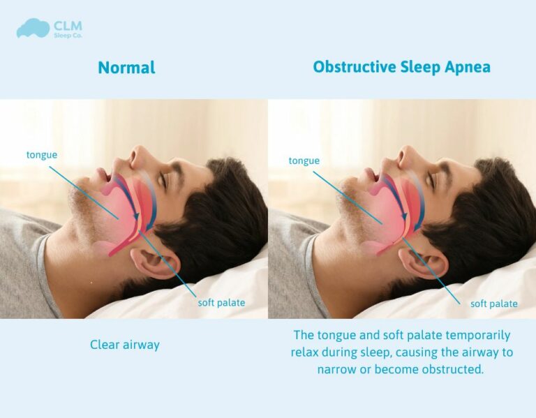 Obstructive Sleep Apnea (OSA) is a common but serious sleep disorder