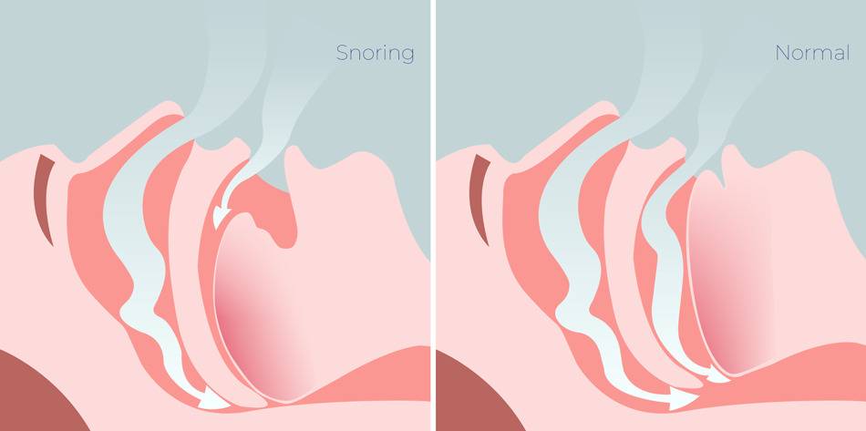 Choking or coughing during sleep is one of the significant sleep apnea symptoms, signaling possible airway obstruction