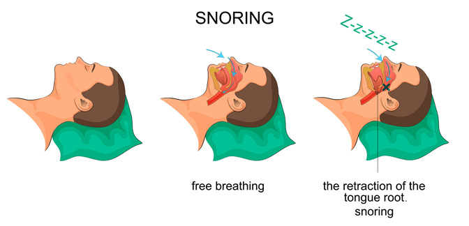 Snoring is a common sign in people with sleep apnea.