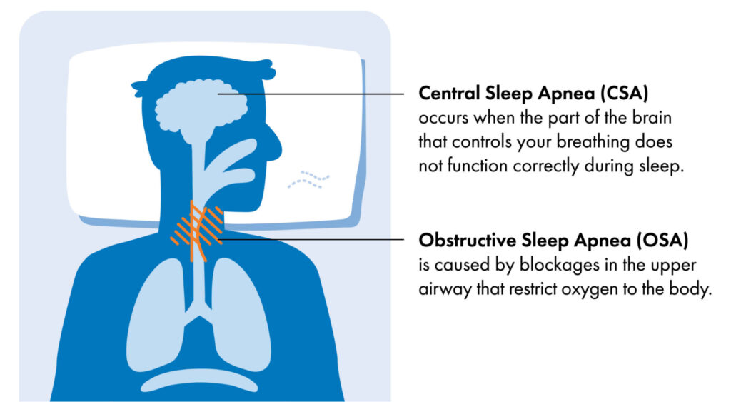 Central Sleep Apnea occurs when the brain does not send the correct signals to the muscles that control breathing