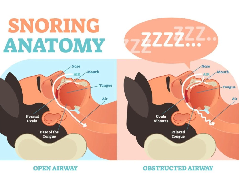 Obstructive sleep apnea might result from the obstruction of airflow caused by swollen tonsils, oversized or big tonsils, and a large tongue