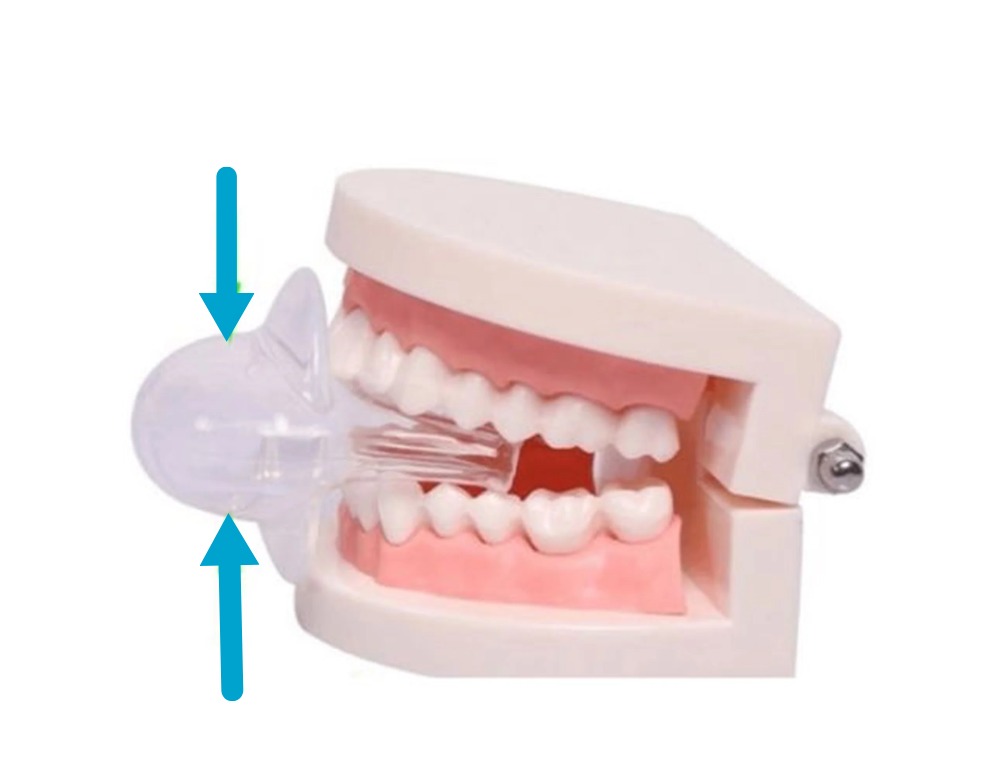 Tongue Retaining Devices (TRDs) are suitable for light to moderate Obstructive Sleep Apnea (OSA) or tongue-related snoring