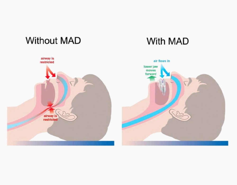 Mandibular advancement devices (MADs) are anti snoring devices Australia