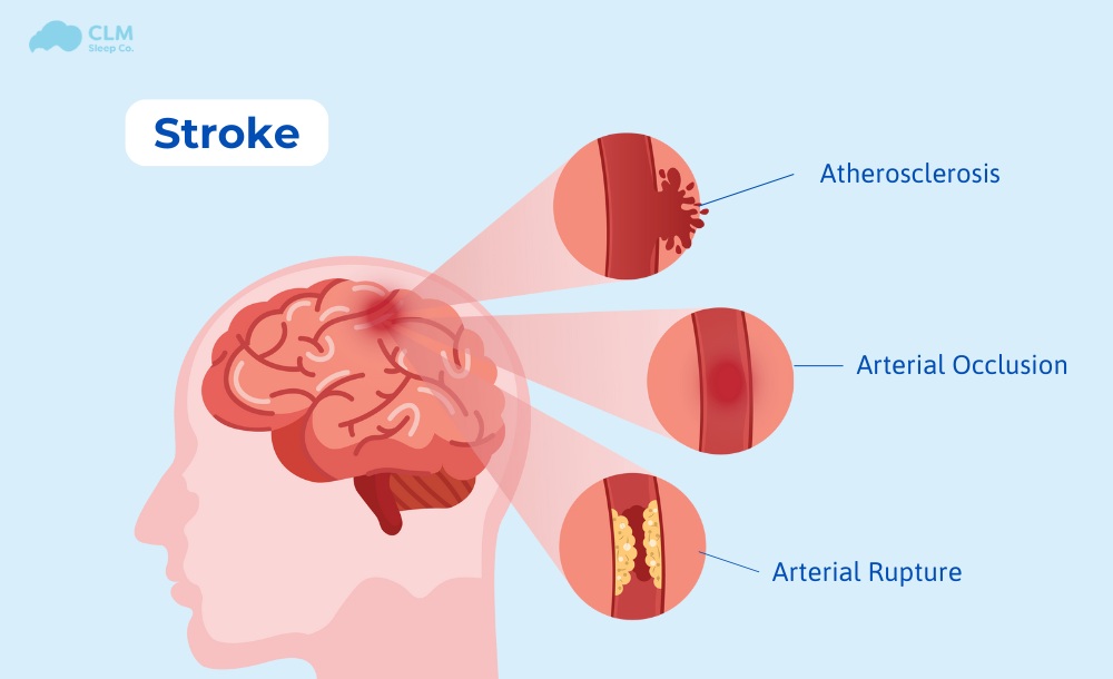 Having sleep apnea can raise the risk of stroke