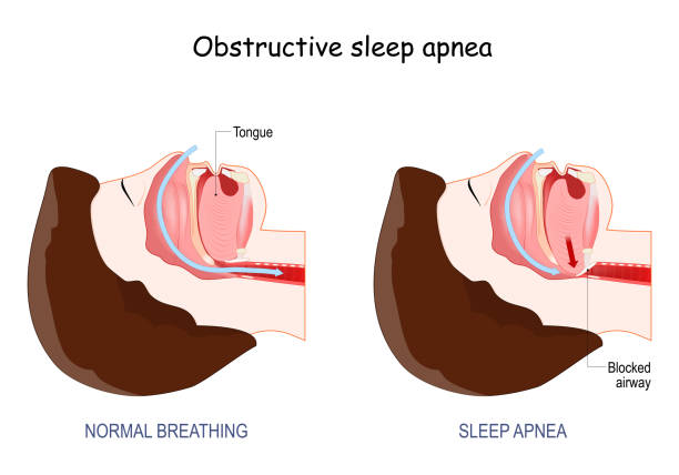 Severe sleep apnea is a serious sleep disorder