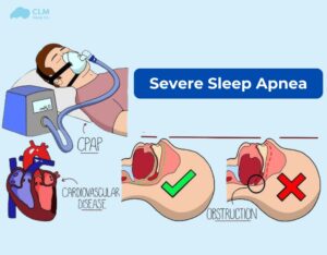 Causes and symptoms of severe sleep apnea