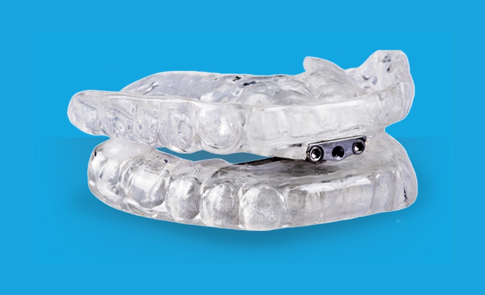 Mandibular Advancement Device (MAD) is a type of sleep apnea mouth guard 