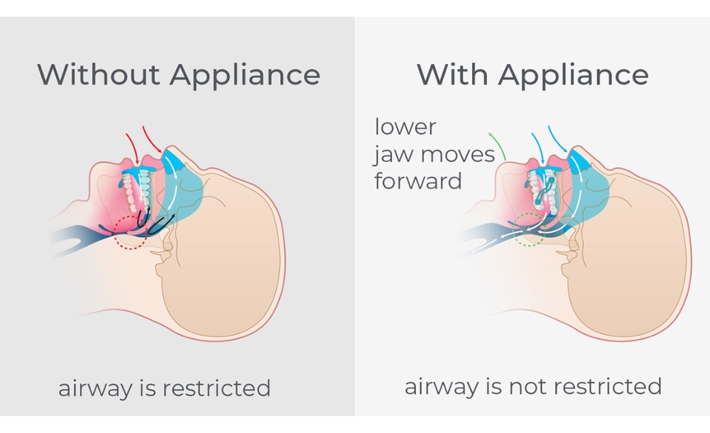 What are the benefits of using a mouth guard for sleep apnea?