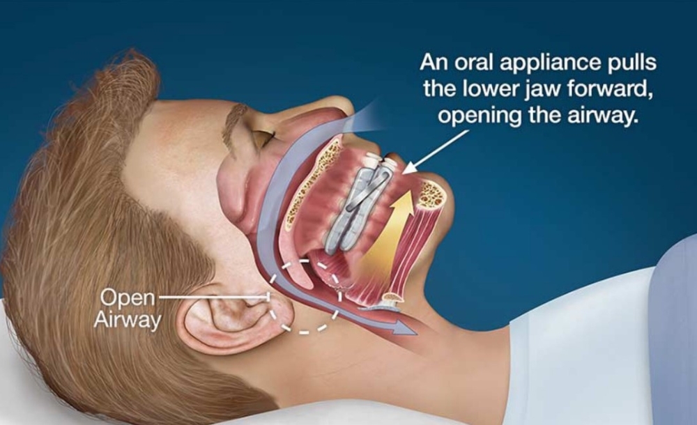 Effectiveness of mouth guards for sleep disorders