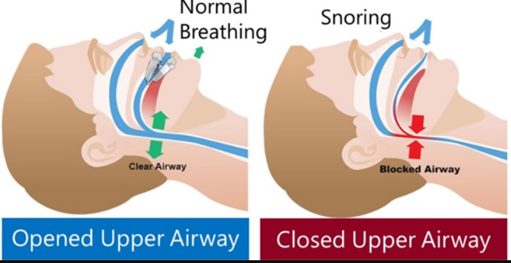 Snoring can be the result of airflow obstruction caused by swollen tonsils, oversized or enlarged tonsils, and a large tongue