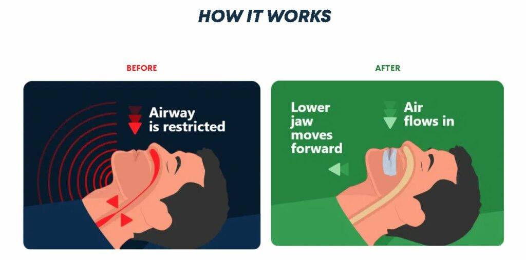 A snoring mouth guard keeps your airway open during sleep to reduce or eliminate snoring