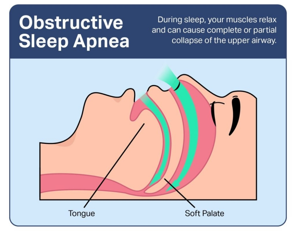 Obstructive Sleep Apnea (OSA)