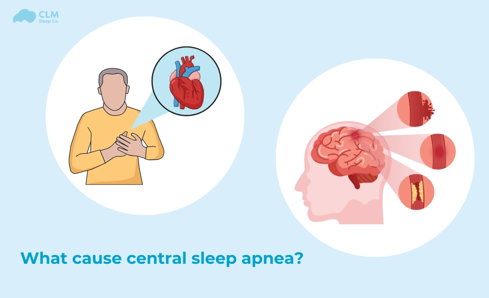 Central Sleep Apnea (CSA)