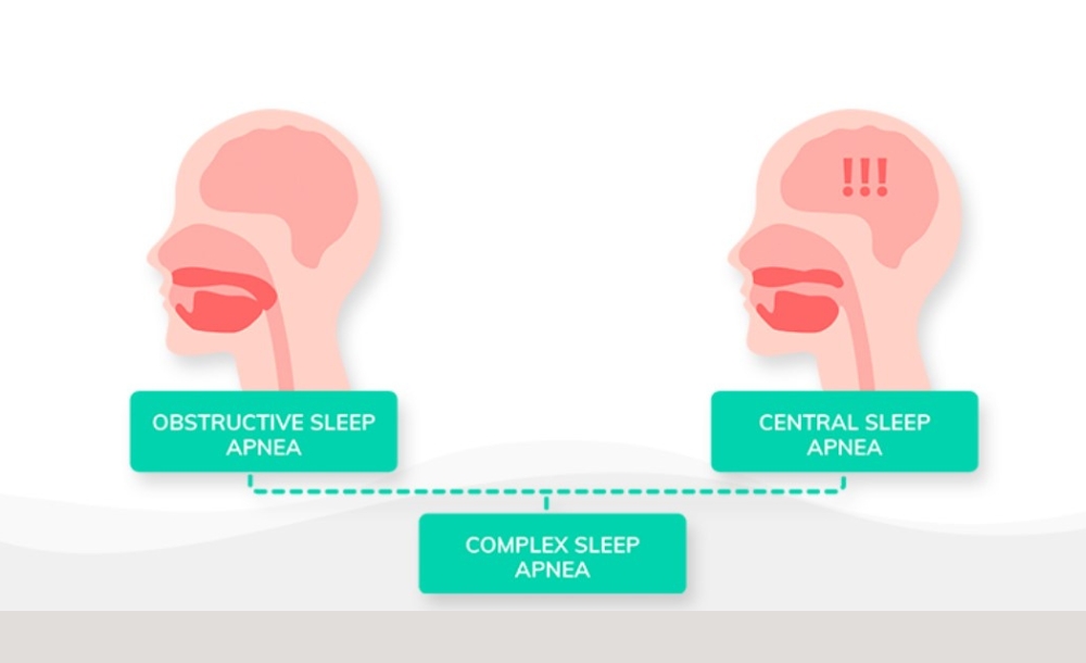 What causes obstructive sleep apnea? 