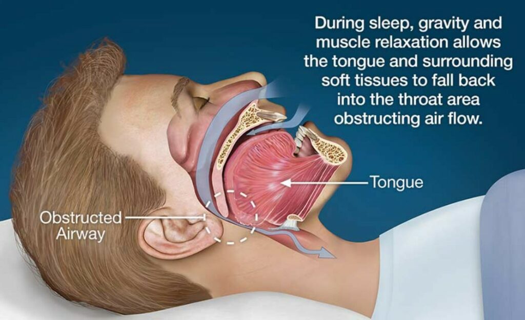 snoring due to airway obstruction