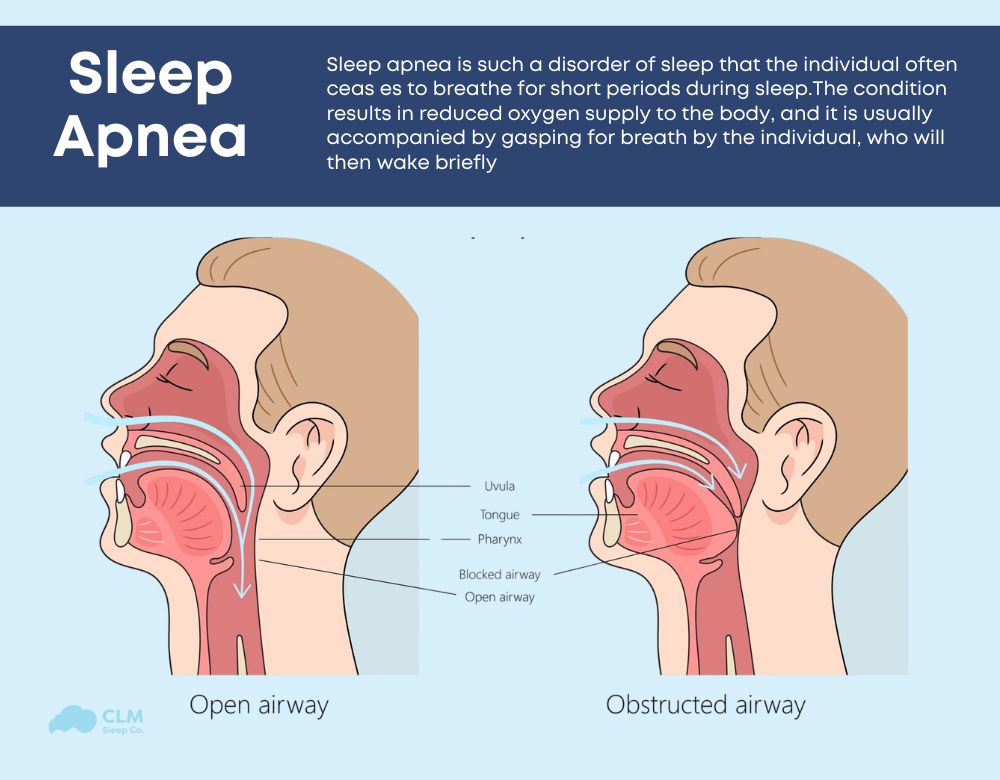 Sleep apnea is a sleep disorder