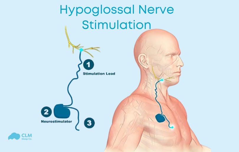 Hypoglossal Nerve Stimulation for Sleep Apnea Treatment