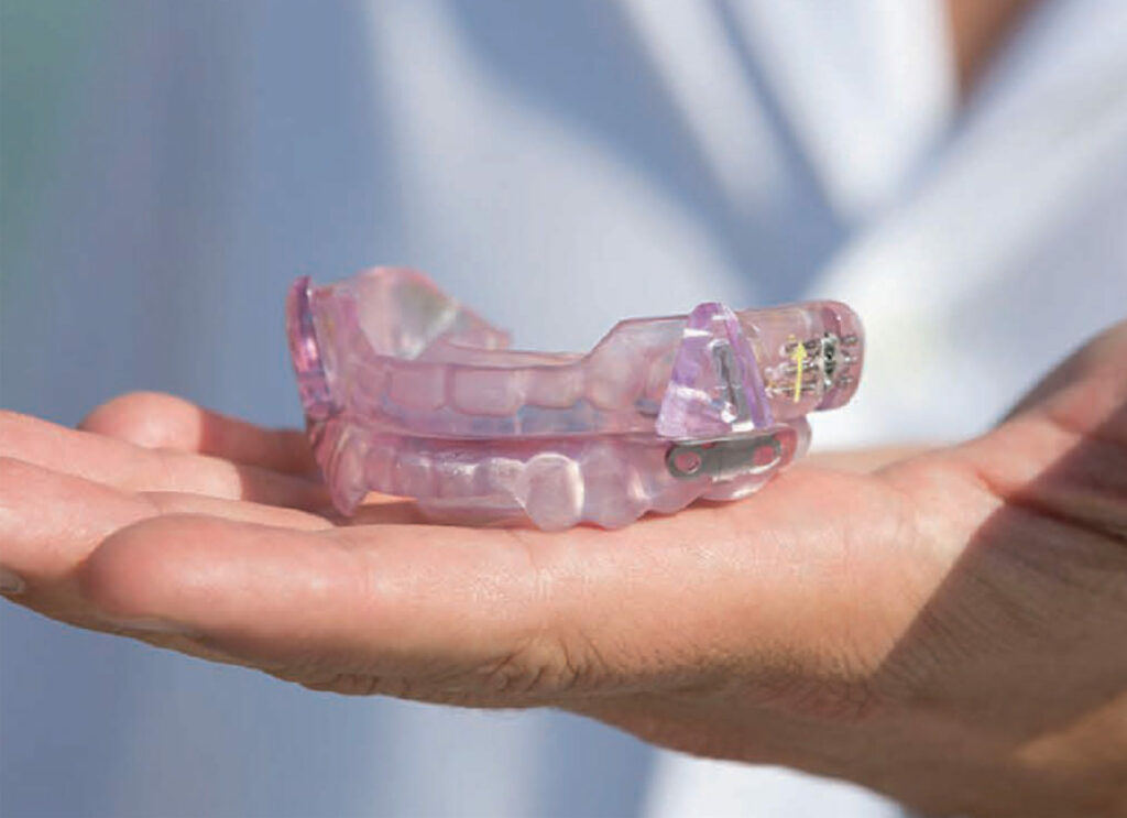 A close-up of a mandibular advancement device used during sleep