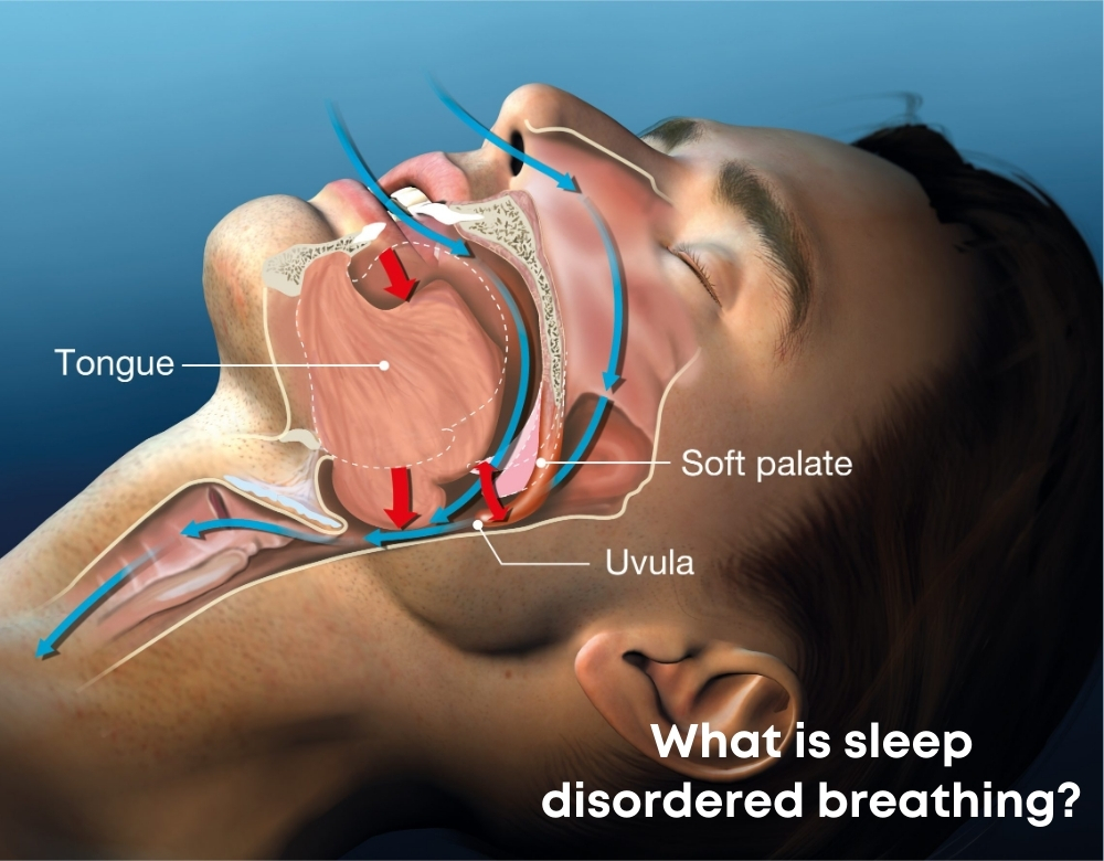 What is sleep disordered breathing?