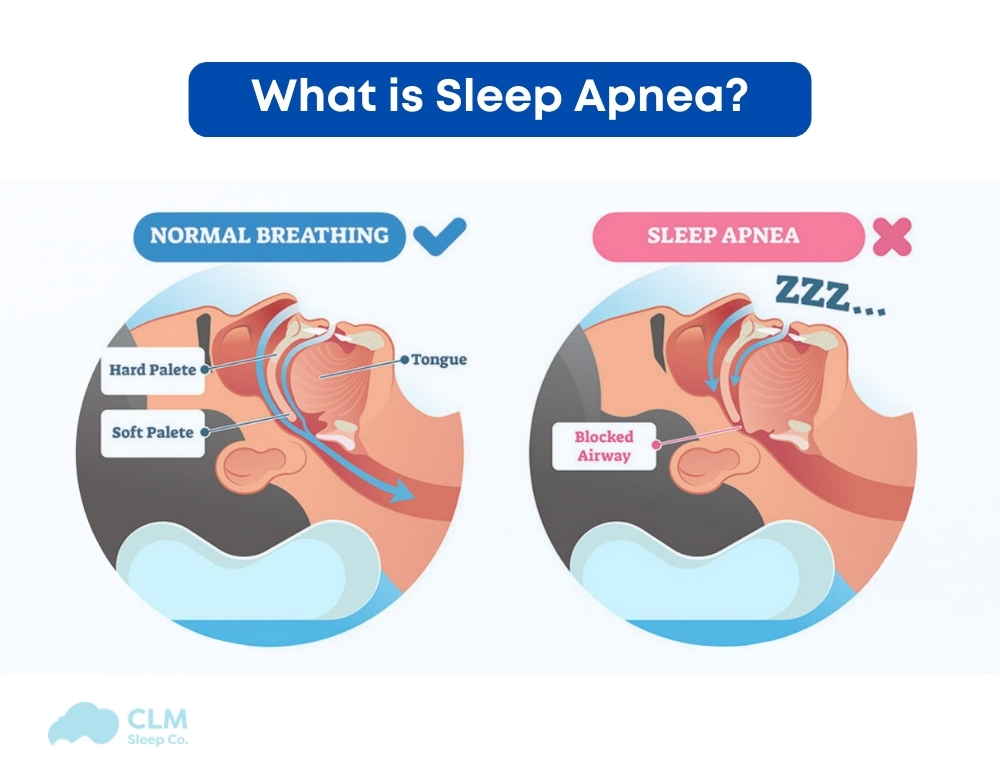 Sleep apnea is a condition where your breathing stops and starts repeatedly during sleep.