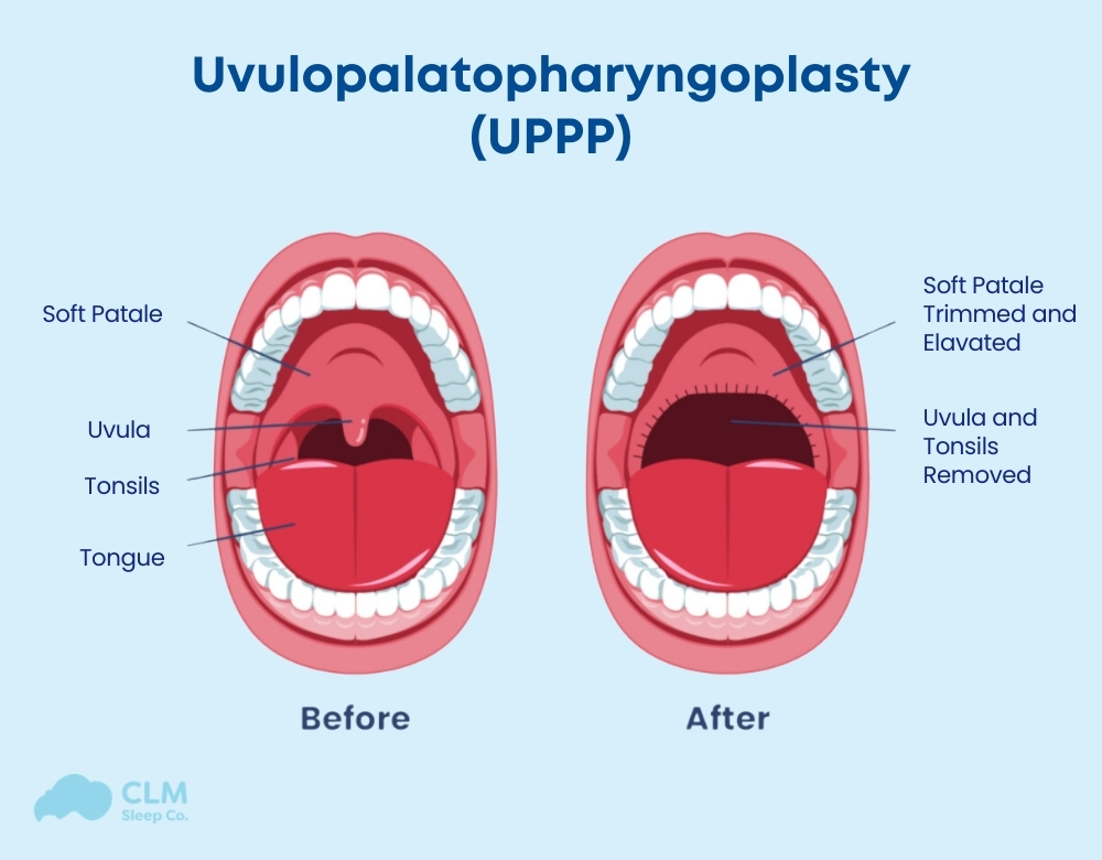 What is the Newest Treatment for Sleep Apnea? UPPP