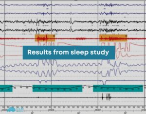 results from sleep study