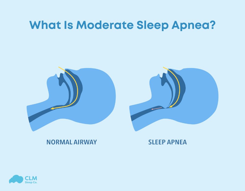 Sleep apnea