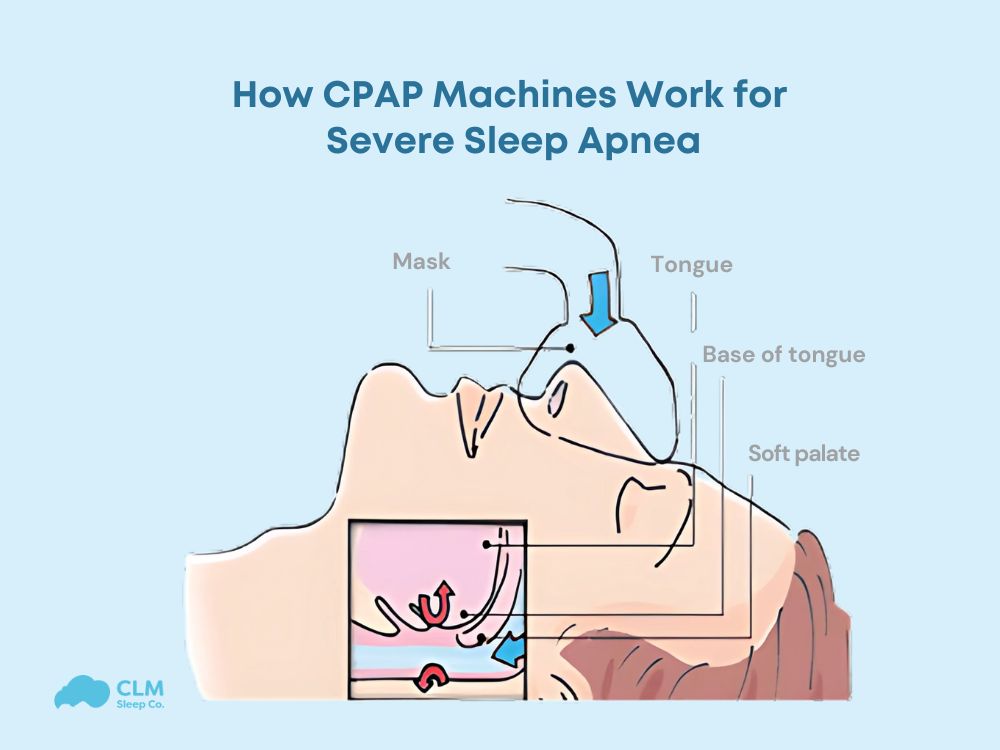 CPAP Therapy