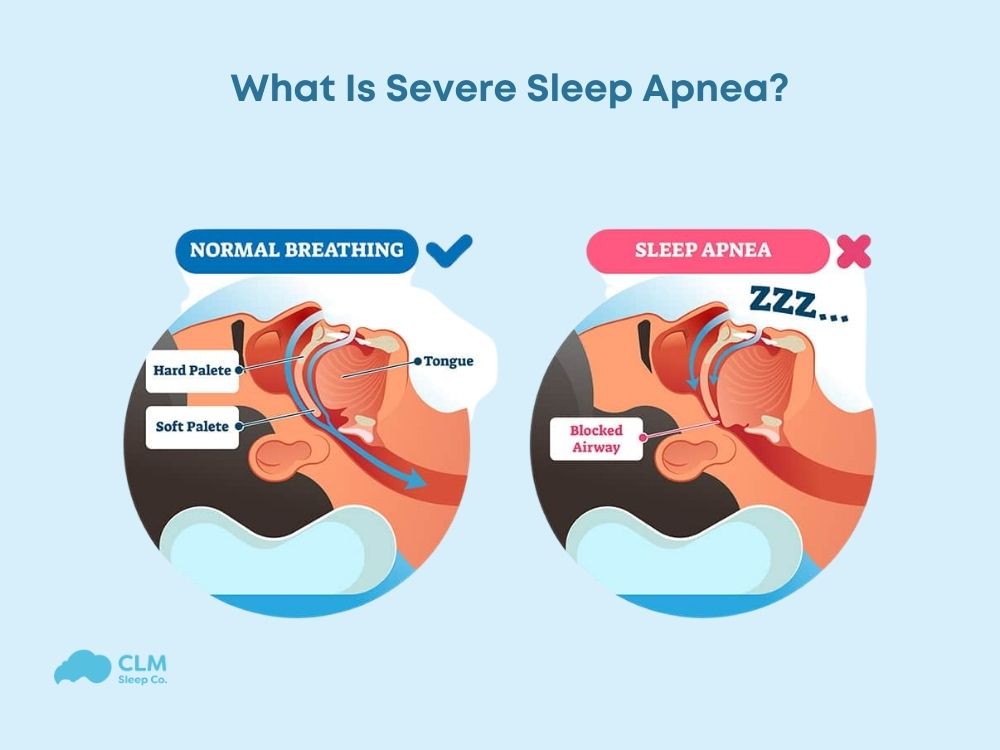 Definition of severe sleep apnea